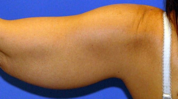 arm fat
